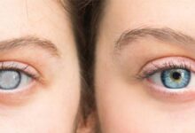 Cataract