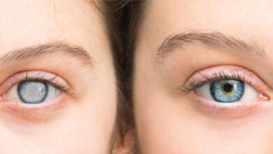 Cataract