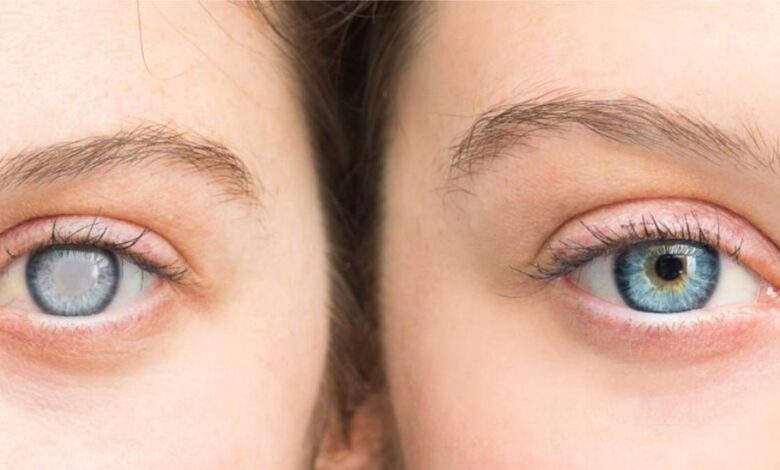 Cataract